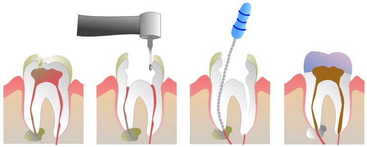 Leczenie kanałowe zębów - Endodoncja